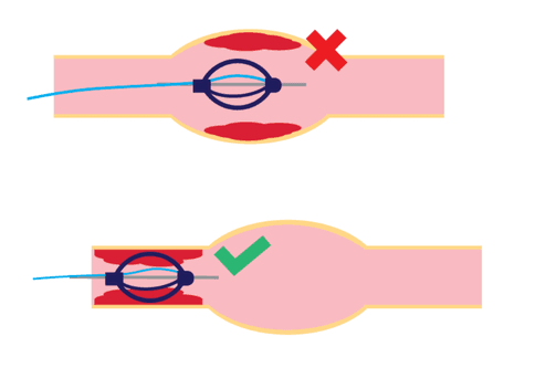 Morphing Thrombectomy Device: concept.